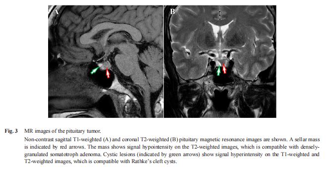 MR images of the pituitary tumor. MR images of the pituitary tumor.