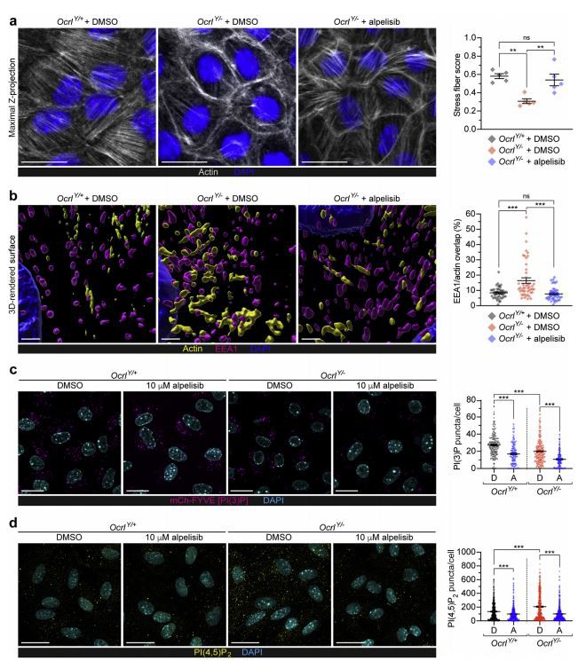 Lowe syndrome/Dent disease