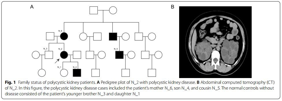 Fig. 1 Family status of polycystic kidney patients. A Pedigree plot of N_2 with polycystic kidney disease. B Abdominal computed tomography (CT)  of N_2. In this fgure, the polycystic kidney disease cases included the patient’s mother N_6, son N_4, and cousin N_5. The normal controls without  disease consisted of the patient’s younger brother N_3 and daughter N_1