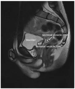 Fig. 1 Preoperative MRI of the pelvis - demonstrating enlarged seminal vesicle cysts in the retrovesical space on the left-hand side. Fig. 1 Preoperative MRI of the pelvis - demonstrating enlarged seminal vesicle cysts in the retrovesical space on the left-hand side.