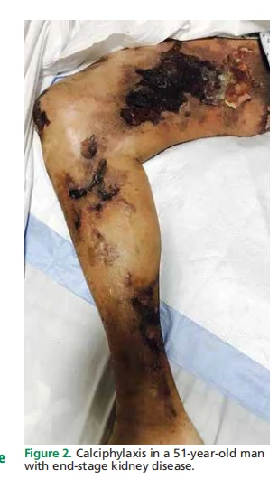 Figure 2. Calciphylaxis in a 51-year-old man with end-stage kidney disease. Figure 2. Calciphylaxis in a 51-year-old man with end-stage kidney disease.